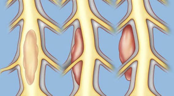 Early Signs of Spine Tumors You Shouldn’t Ignore