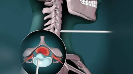 Endoscopic Cervical Spine Surgery Offers Faster Recovery for Patients in Kolkata