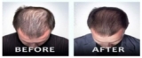 Is a New Jersey Hair Loss Treatment Center the Secret to Regrowing Your Confidence?