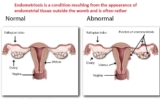 Interventional Radiology advances in medical practice offer alternative to open surgery treatment of symptomatic Uterine Fibroids.